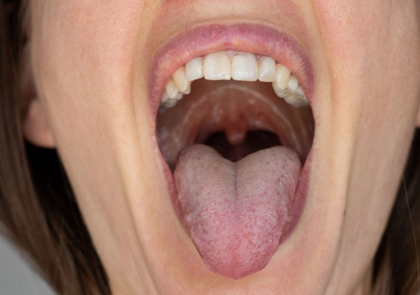 Гъбички в устата – домашни средства за лечение