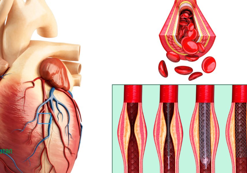 Митрална стеноза