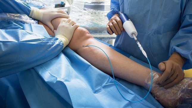 Разширени вени 4