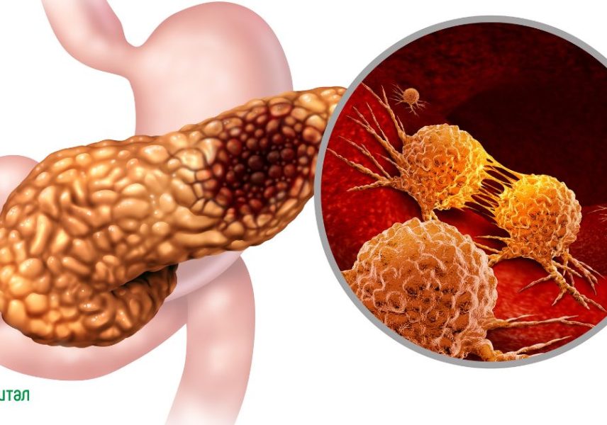 рак на панкреаса