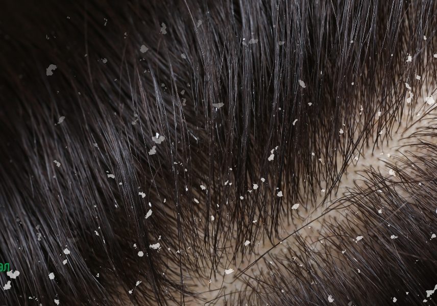 8 признаци за недостиг на витамини - Здравитал 6 8 признаци за недостиг на витамини - Здравитал 6