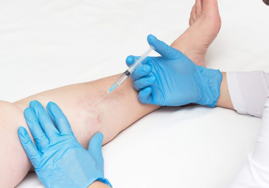 Разширени вени 7 Разширени вени 7