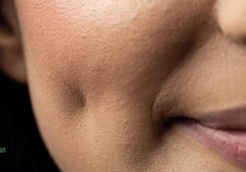 Акне на лицето - карта с която да разберете - Здравитал 6 Акне на лицето - карта с която да разберете - Здравитал 6