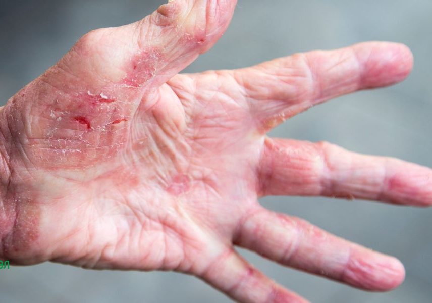 Херпетиформен дерматит