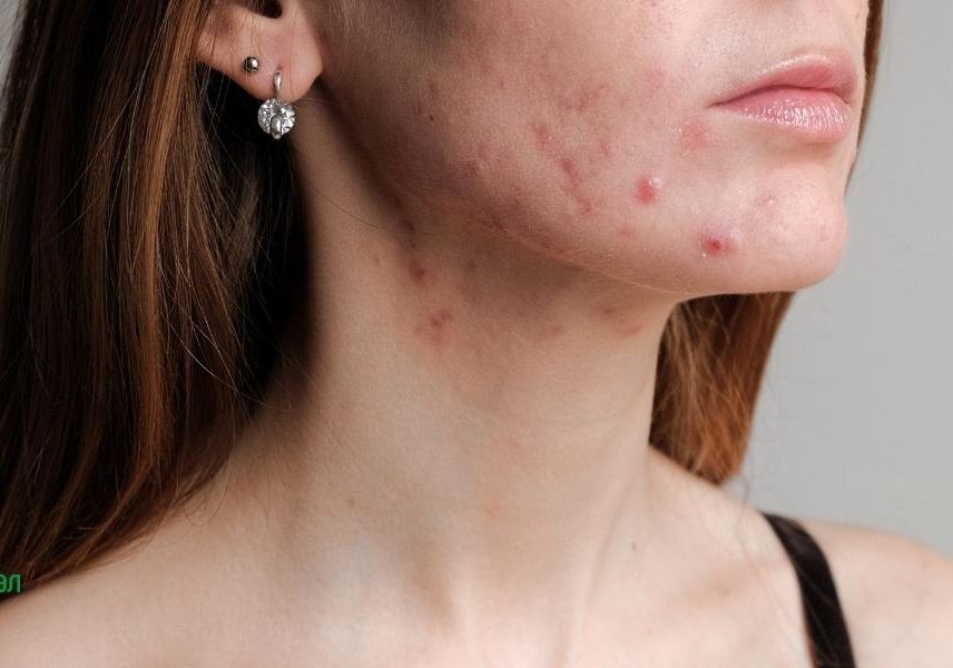 Акне на лицето - карта с която да разберете - Здравитал 3 Акне на лицето - карта с която да разберете - Здравитал 3