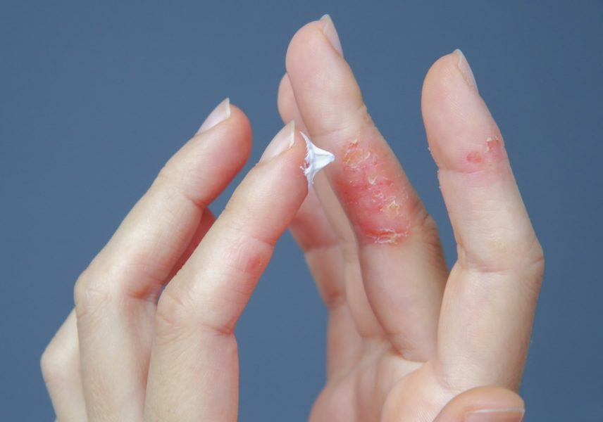 Екзема – всичко, което трябва да знаете за нея 03 Екзема – всичко, което трябва да знаете за нея 03