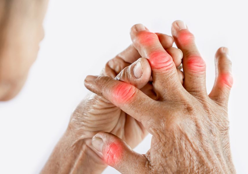 Подуване на пръстите - симптоми и лечение 15 Подуване на пръстите - симптоми и лечение 15