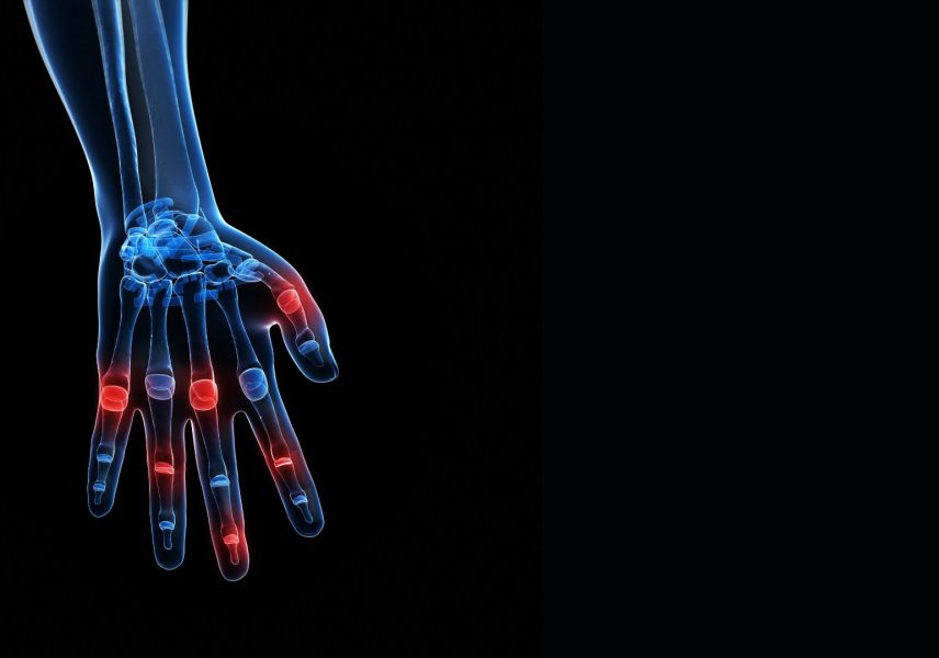 Подуване на пръстите - симптоми и лечение 16 Подуване на пръстите - симптоми и лечение 16