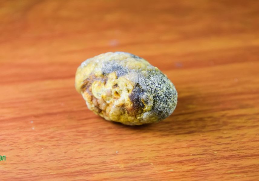 Камък в жлъчка