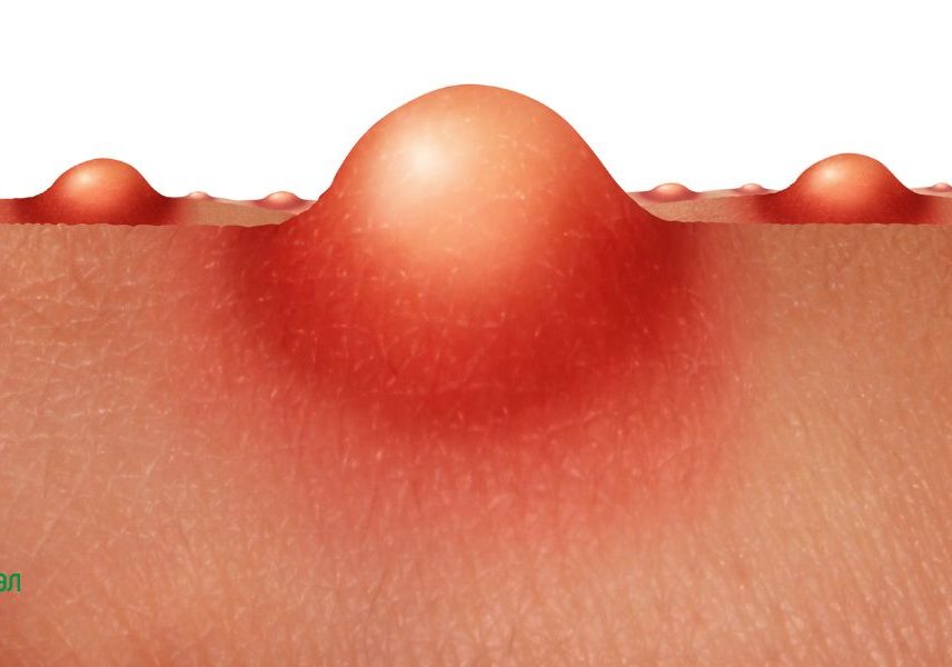 Пробиотици срещу акне: акне