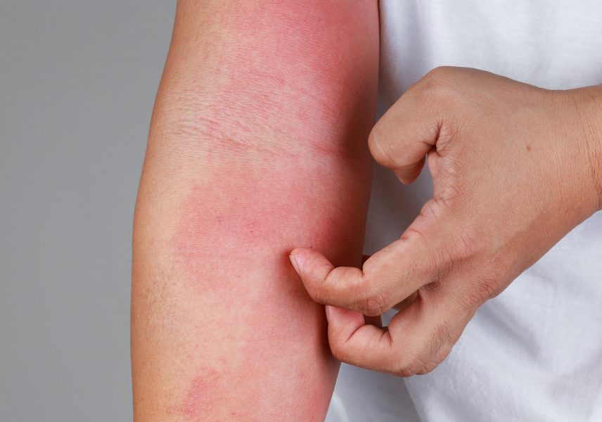 Екзема – всичко, което трябва да знаете за нея 02 Екзема – всичко, което трябва да знаете за нея 02