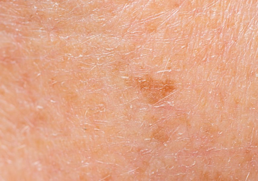 Подуване на пръстите - симптоми и лечение 18 Подуване на пръстите - симптоми и лечение 18