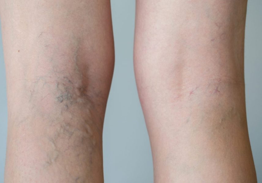 Разширени вени razshireni-veni-zdravital