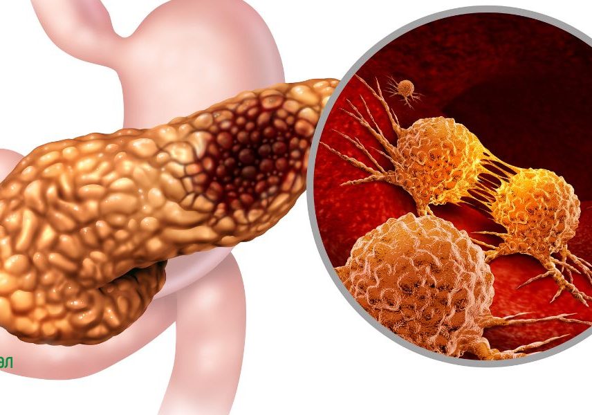 жлъчнокаменен панкреати