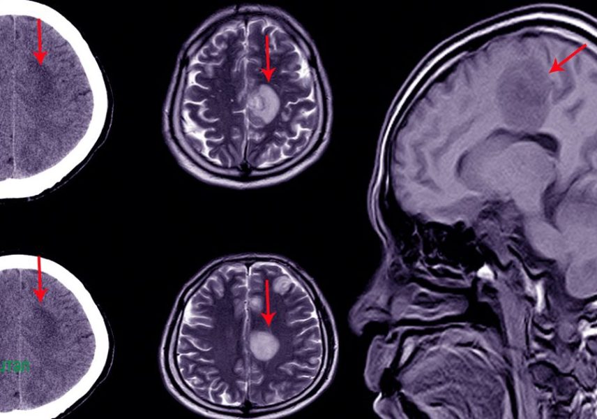 Хидроцефалия