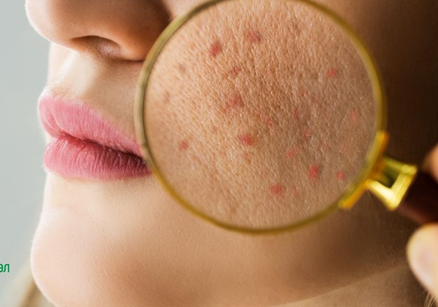 Пробиотици срещу акне: кожен проблем