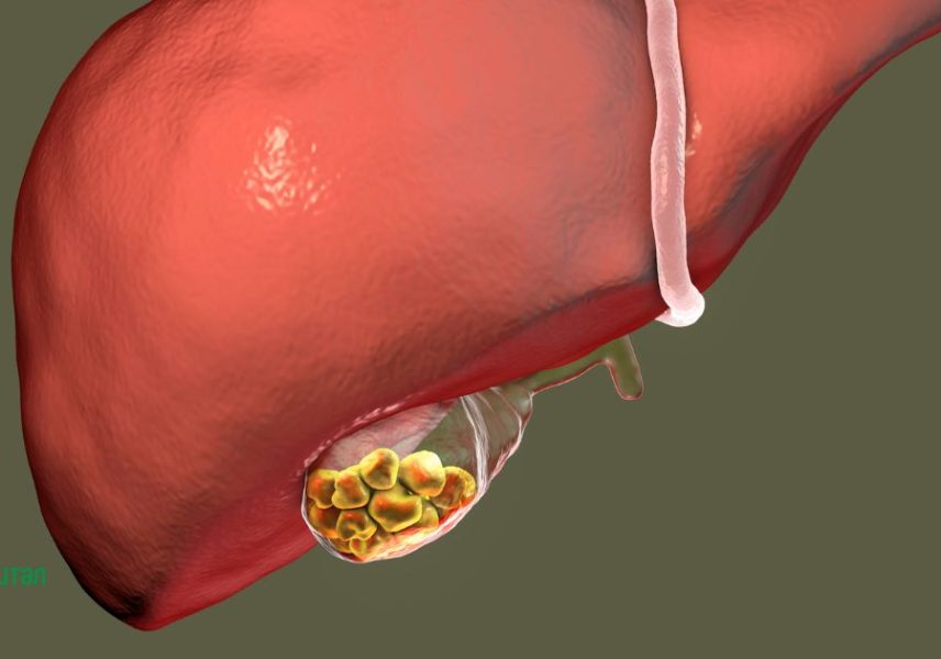 жлъчно-чернодробна и панкреатична хирургия: камъни в жлъчен мехур