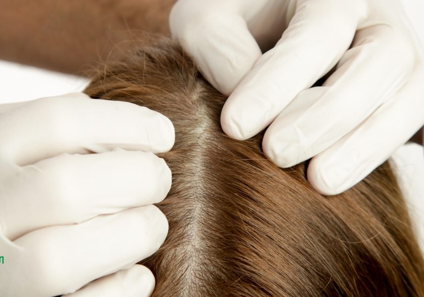 6 ползи за косата от копривата - мнение на дерматолозите 3