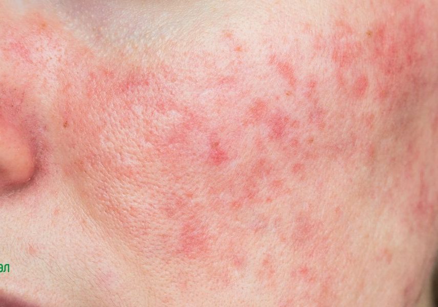 розацея
