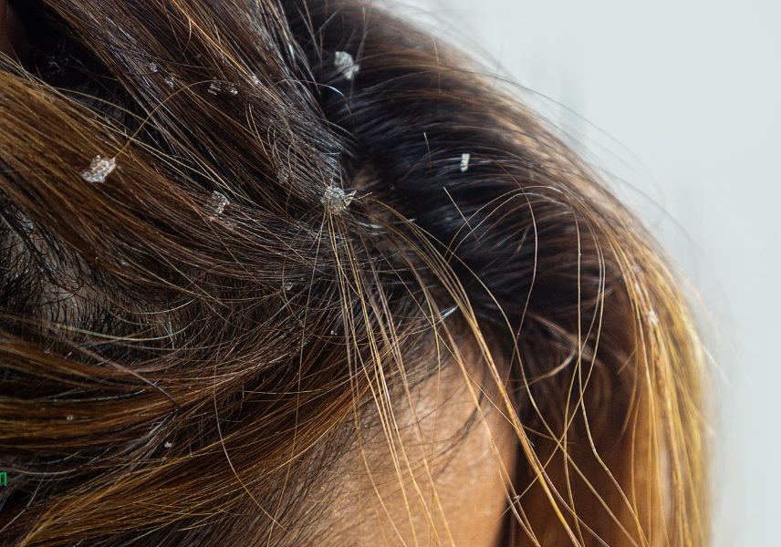 6 ползи за косата от копривата - мнение на дерматолозите 5