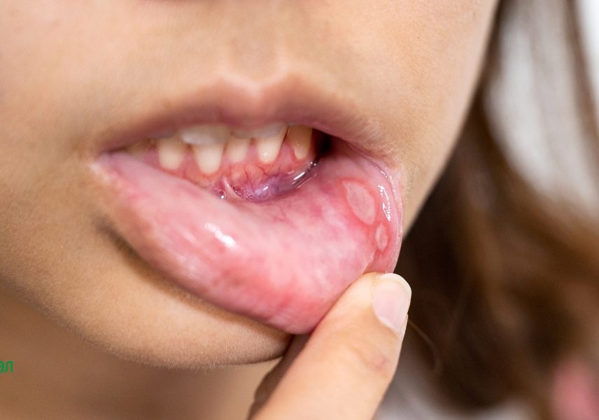 8 признаци за недостиг на витамини - Здравитал 3 8 признаци за недостиг на витамини - Здравитал 3