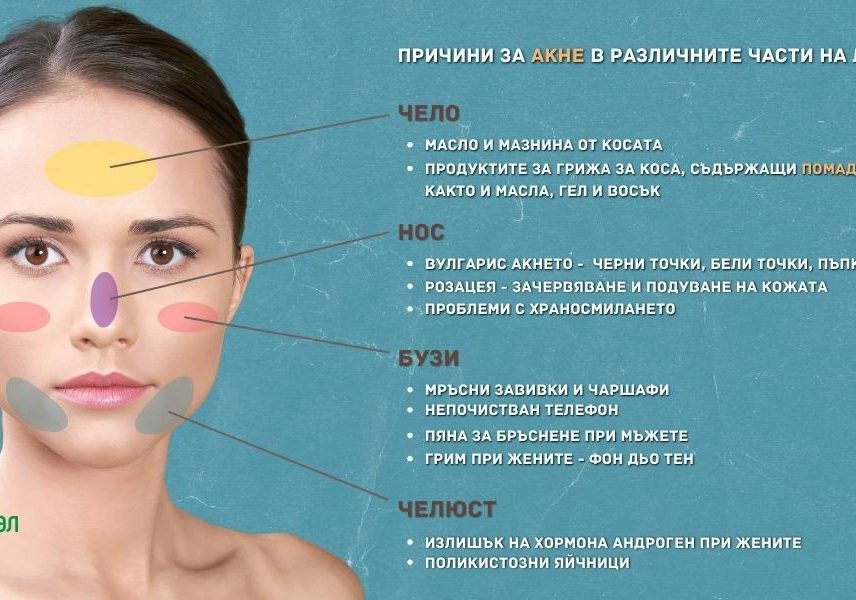 Акне на лицето - карта с която да разберете - Здравитал 2 Акне на лицето - карта с която да разберете - Здравитал 2