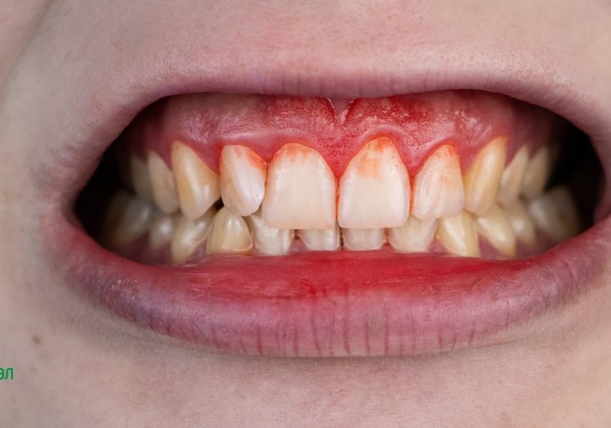 8 признаци за недостиг на витамини - Здравитал 4 8 признаци за недостиг на витамини - Здравитал 4