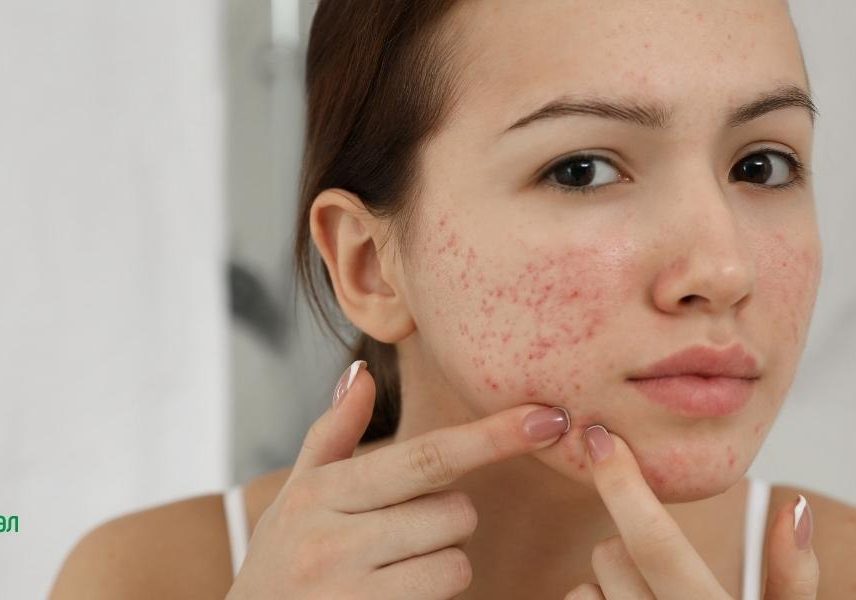 Акне на лицето - карта с която да разберете - Здравитал akne-na-litseto-karta-s-koyato-da-razberete