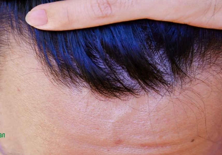 Акне на лицето - карта с която да разберете - Здравитал 5 Акне на лицето - карта с която да разберете - Здравитал 5