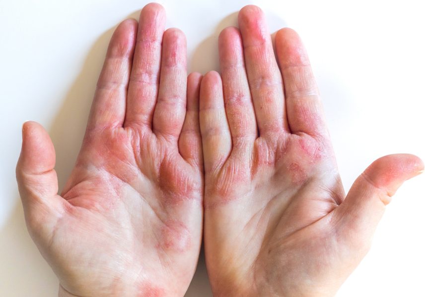 Екзема – всичко, което трябва да знаете за нея 01 ekzema-vsichko-koeto-tryabva-da-znaete-za-neya-zdravital 01