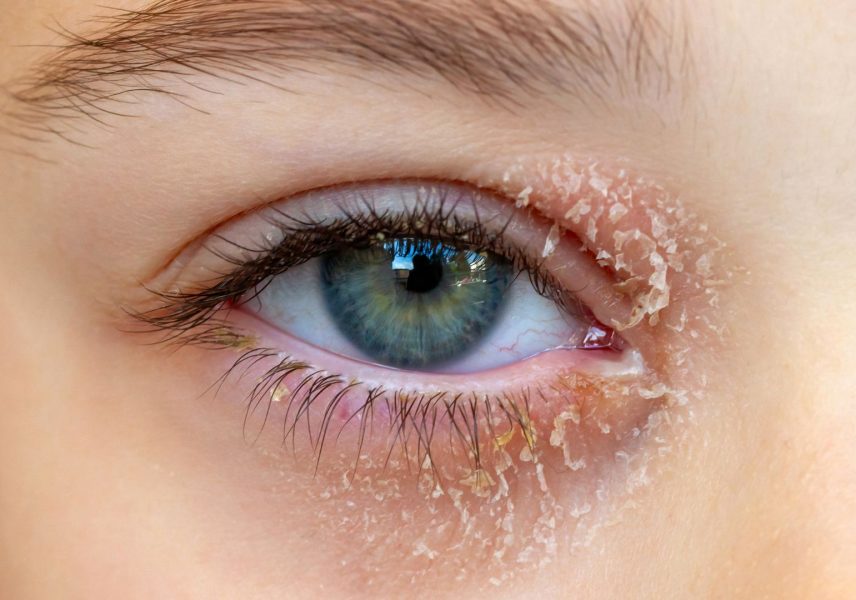 Домашно лечение на блефарит