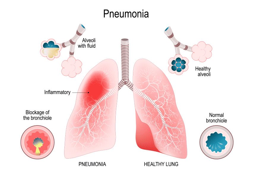 Пневмония и превантивни мерки - Академия Здравитал 1 pnevmonia-i-prevantivni-merki-akademia-zdravital