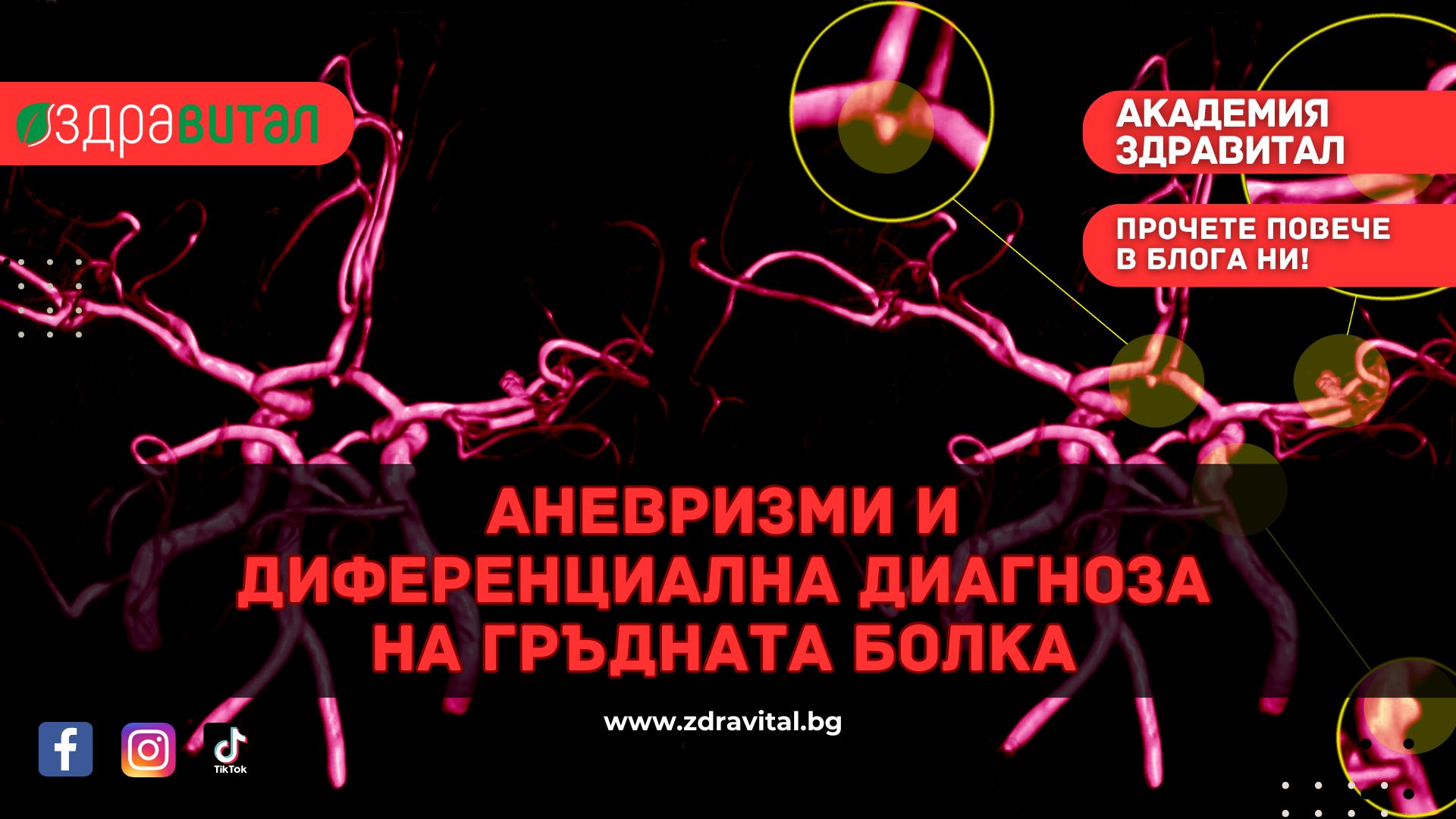 Аневризми и диференциална диагноза на гръдната болка – „Академия Здравитал“