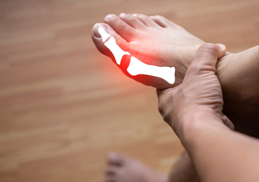 съвети при подагра