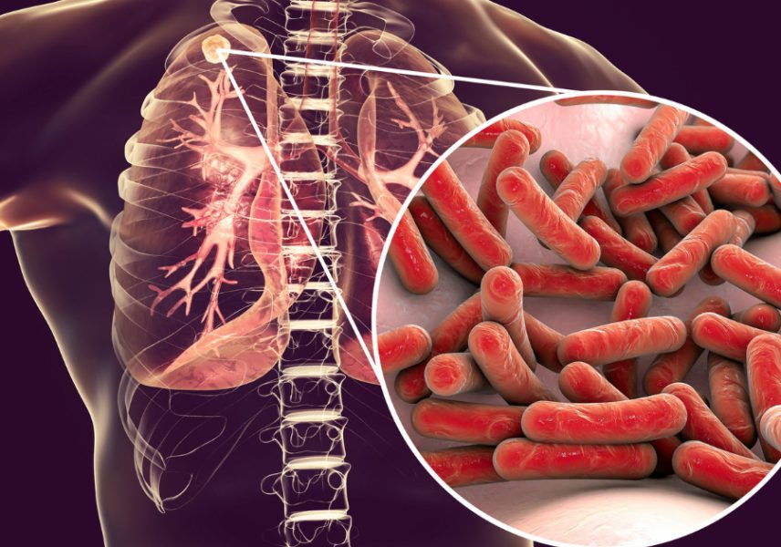 Какво да правим при туберкулоза