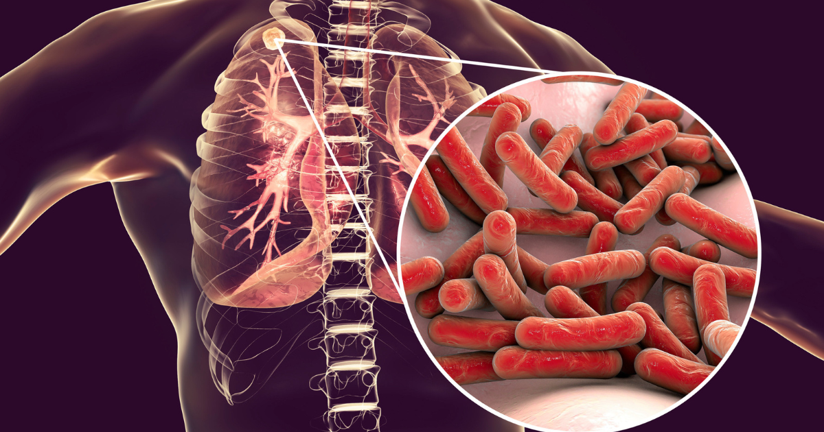 Какво да правим при туберкулоза: Практически насоки