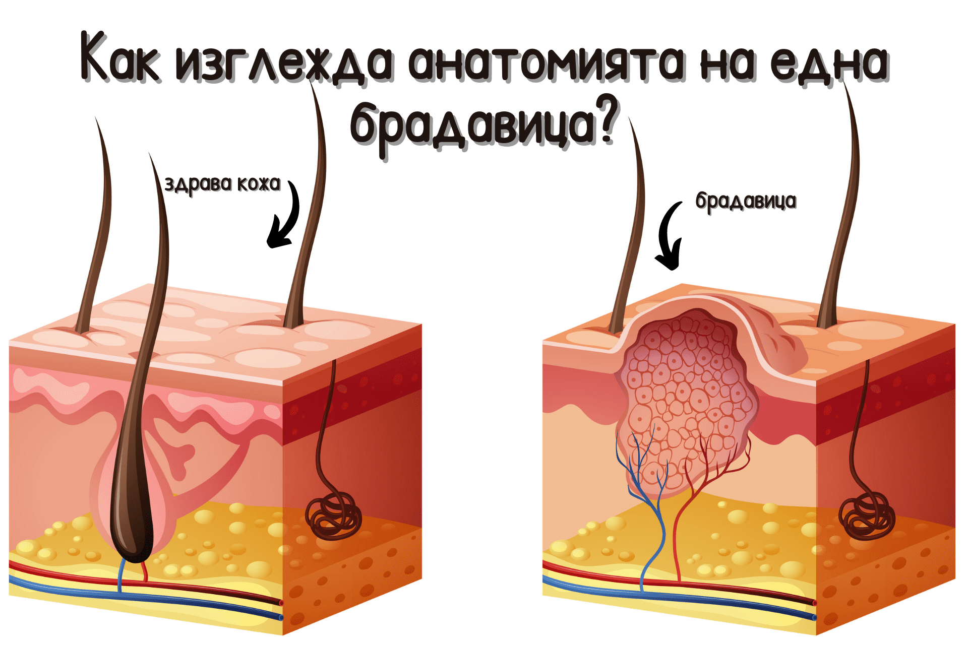 Как да се отървем от брадавиците и веруките?