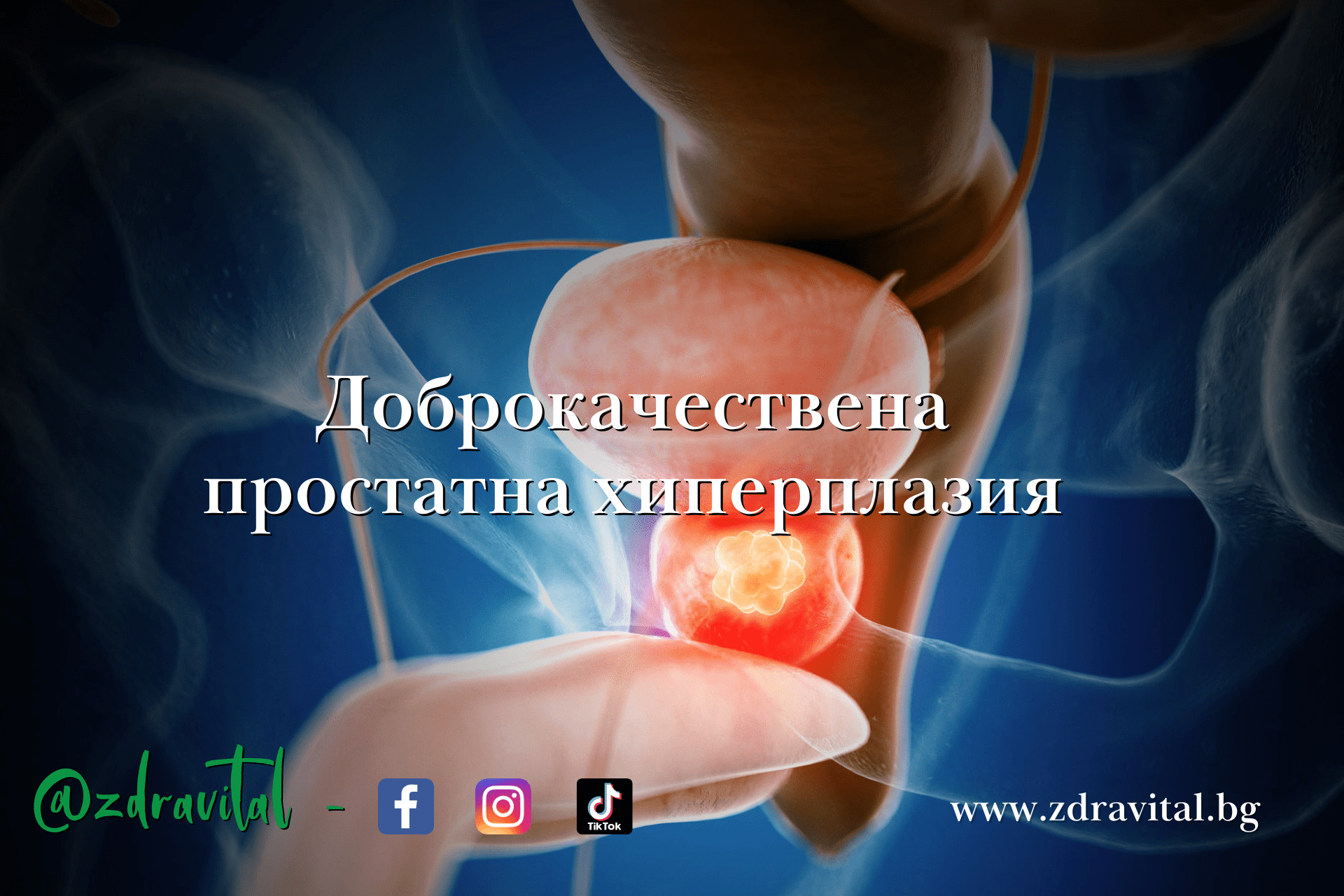 Доброкачествена хиперплазия на простатата
