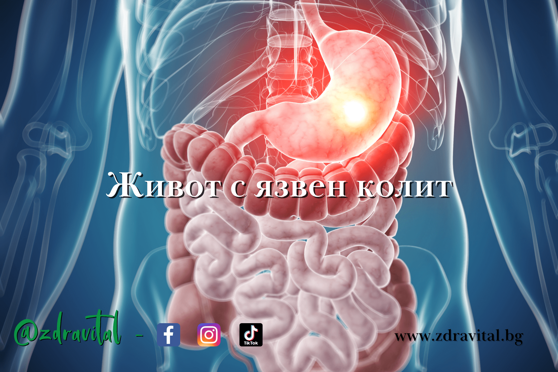 Да живееш с язвен колит