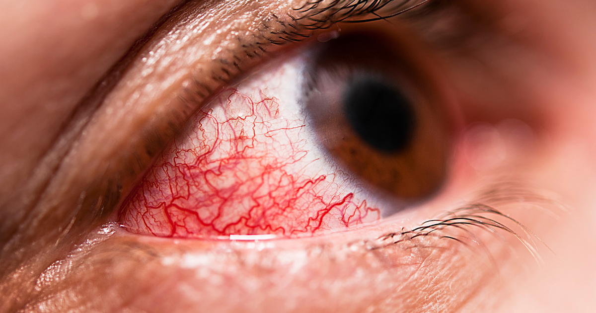 Конюнктивит – Домашно Лечение: Най-Ефективните Начини за Бързо Отстраняване на Проблема