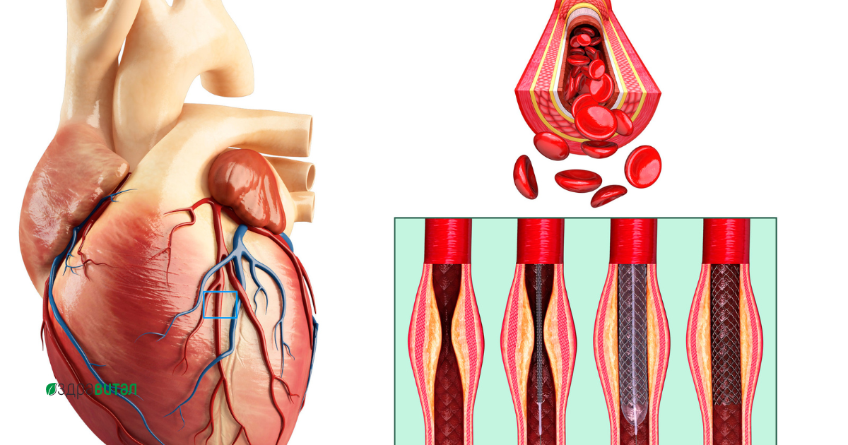 mitralna-i-aortna-stenoza