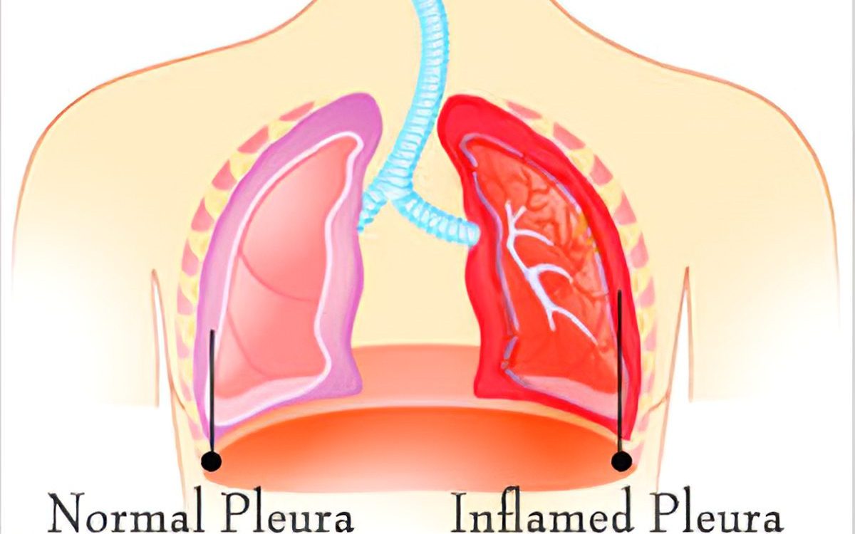 Пневмония и превантивни мерки - Академия Здравитал 2