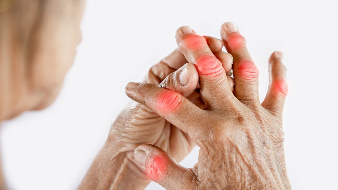 Подуване на пръстите - симптоми и лечение 15
