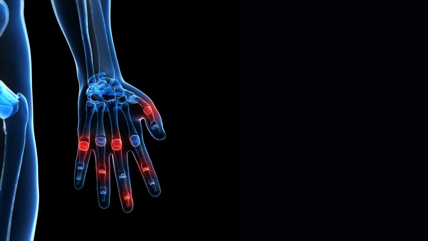 Подуване на пръстите - симптоми и лечение 16