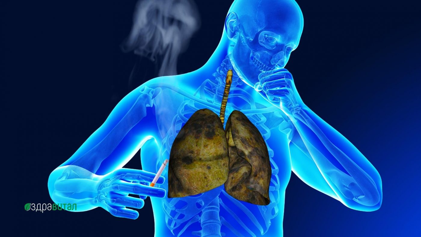 Какво представлява кашлицата при пушачи? 3