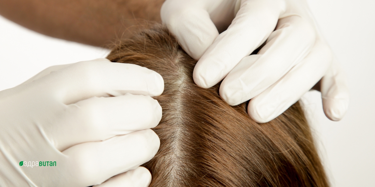 6 ползи за косата от копривата - мнение на дерматолозите 3