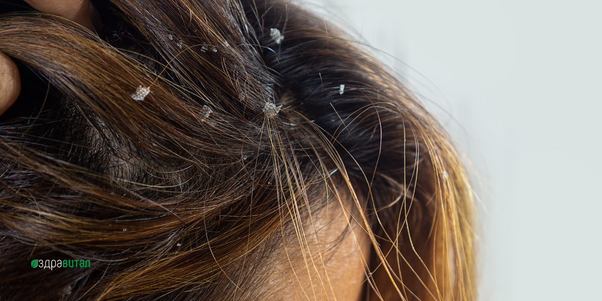 6 ползи за косата от копривата - мнение на дерматолозите 5