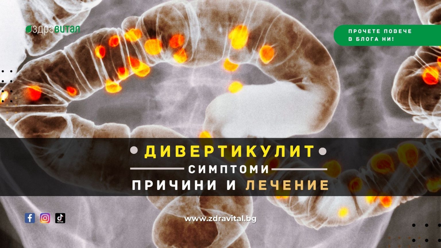 Дивертикулит - симптоми, причини и лечение - Здравитал