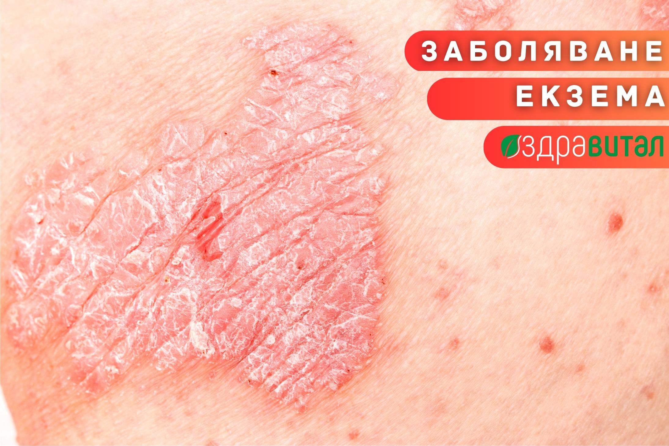 Екзема - Здравитал