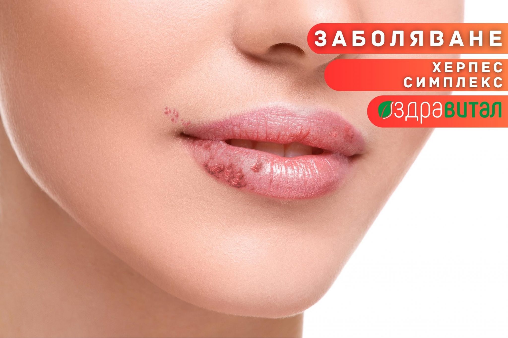 Херпес Симплекс - Здравитал